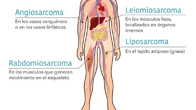 ¿Qué es un sarcoma y qué tipos de sarcomas existen?